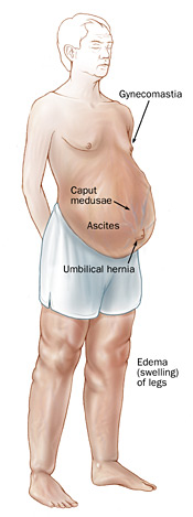 Portal Hypertension | Johns Hopkins Medicine