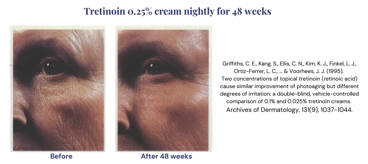 Before and after photos of the retinoid Tretinoin 0.25- cream for 48 weeks.webp