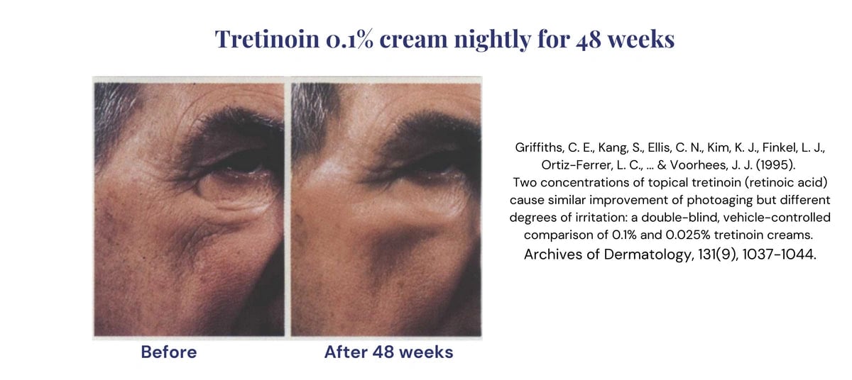 Before and after photos of the retinoid Tretinoin 0.1- cream for 48 weeks.webp