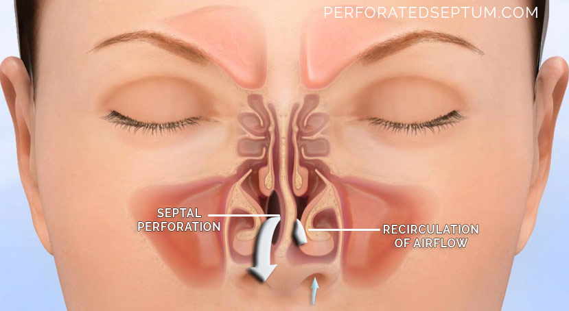 Cocaine Nose Treatment: Effects on the Nose