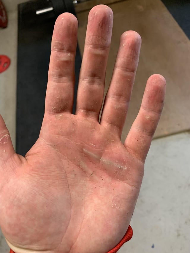 r/weightlifting - Anyone got any experience with these calluses / skin folds (no idea what to call them) in the middle of the hands? Info in comments.