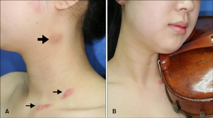 Violin Hickey