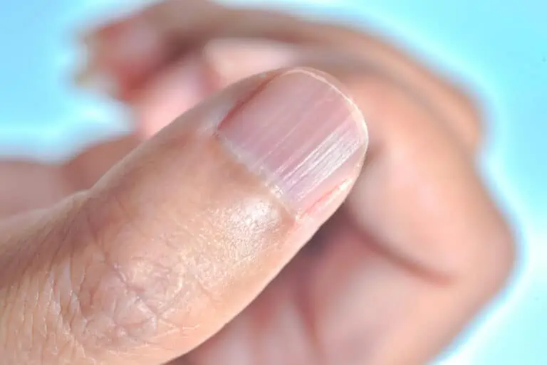 Your nails may hold subtle clues to your overall health. So, what does it mean if you have fingernail ridges? They’re not uncommon, especially with age, and usually, they’re nothing to worry about. Occasionally, however, vertical ridges on nails can be a sign of an underlying medical issue, as can deeper horizontal ridges on nails. What exactly do ridges indicate? Read on for answers and to learn how to get rid of ridges on nails.