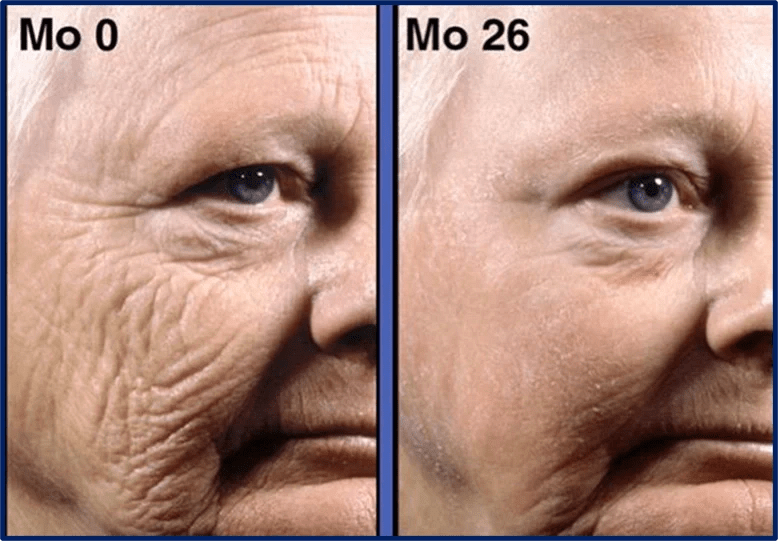 tretinoin before and after