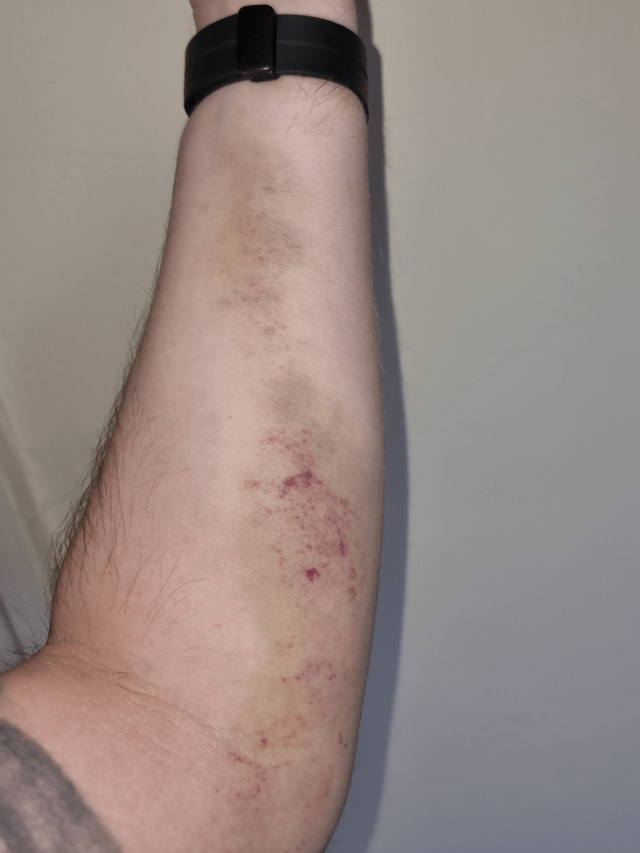 Went to tag archery, they didn't give us any forearm protection. :  r/Wellthatsucks